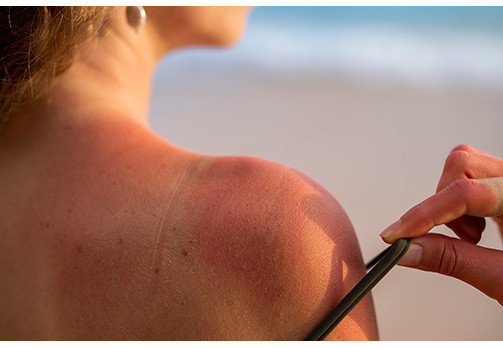Cremes para acalmar a pele após a exposição solar.